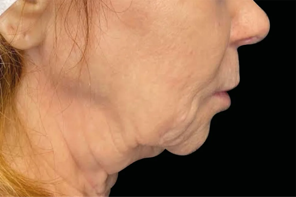 EMface facial toning London - before photo of the neck in profile Neck in profile before EMface facial toning at our London clinic