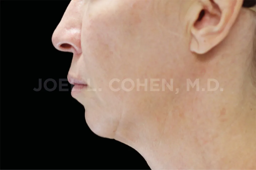 EMface facial toning London - before photo of the jawline and neck in profile Jawline and neck in profile before EMface facial toning at our London clinic